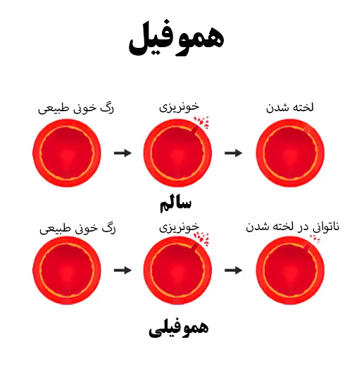 پیشگیری از مشکلات خونریزی هموفیلی با داروی هلمیبرا